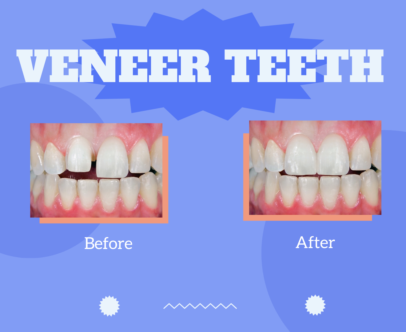 veneer-teeth